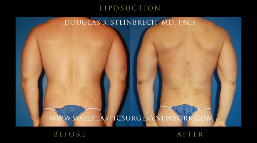 liposuction for men in chicago