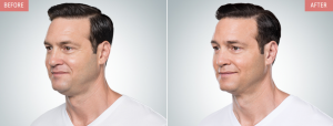 Kybella for men before and after photo
