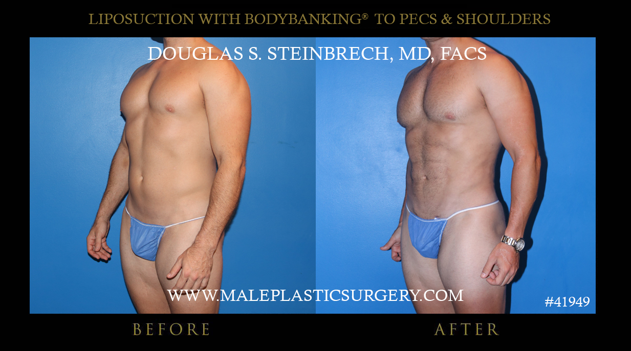 penile implant before after