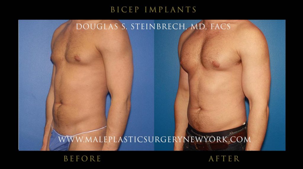 bicep implants for men