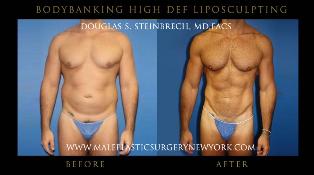 Male Bodybanking High Def Liposculpting Before and After