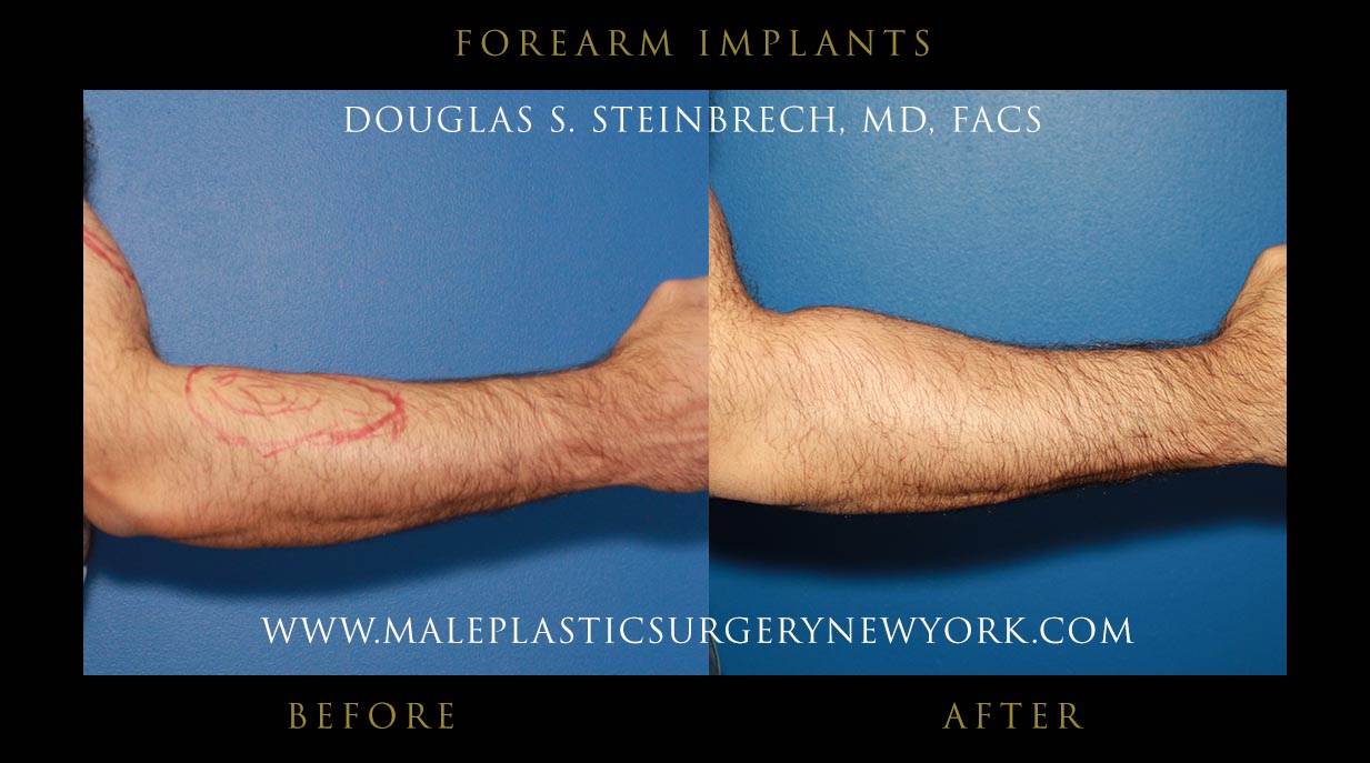 forearm implants for men in chicago
