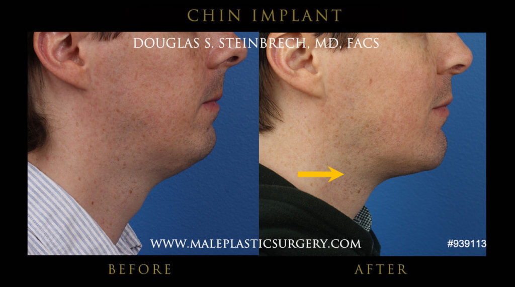 Male Chin Implant Before and After