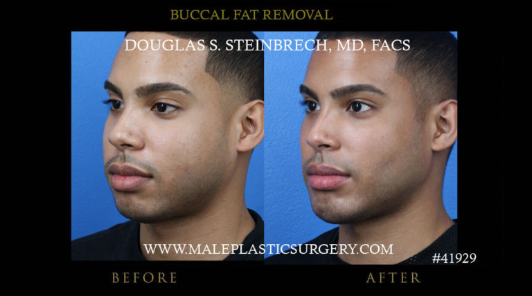 Buccal Fat Removal for Men in Chicago - Male Plastic SurgeryMale