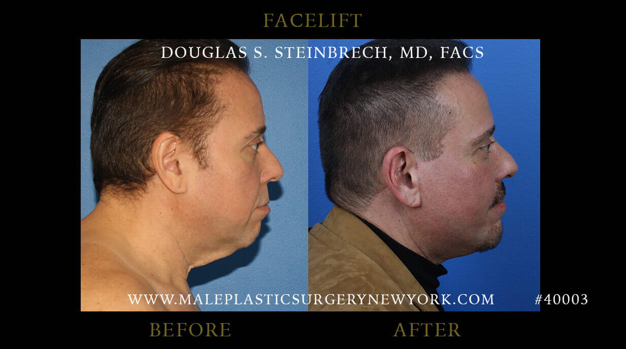 men facelifts before & after