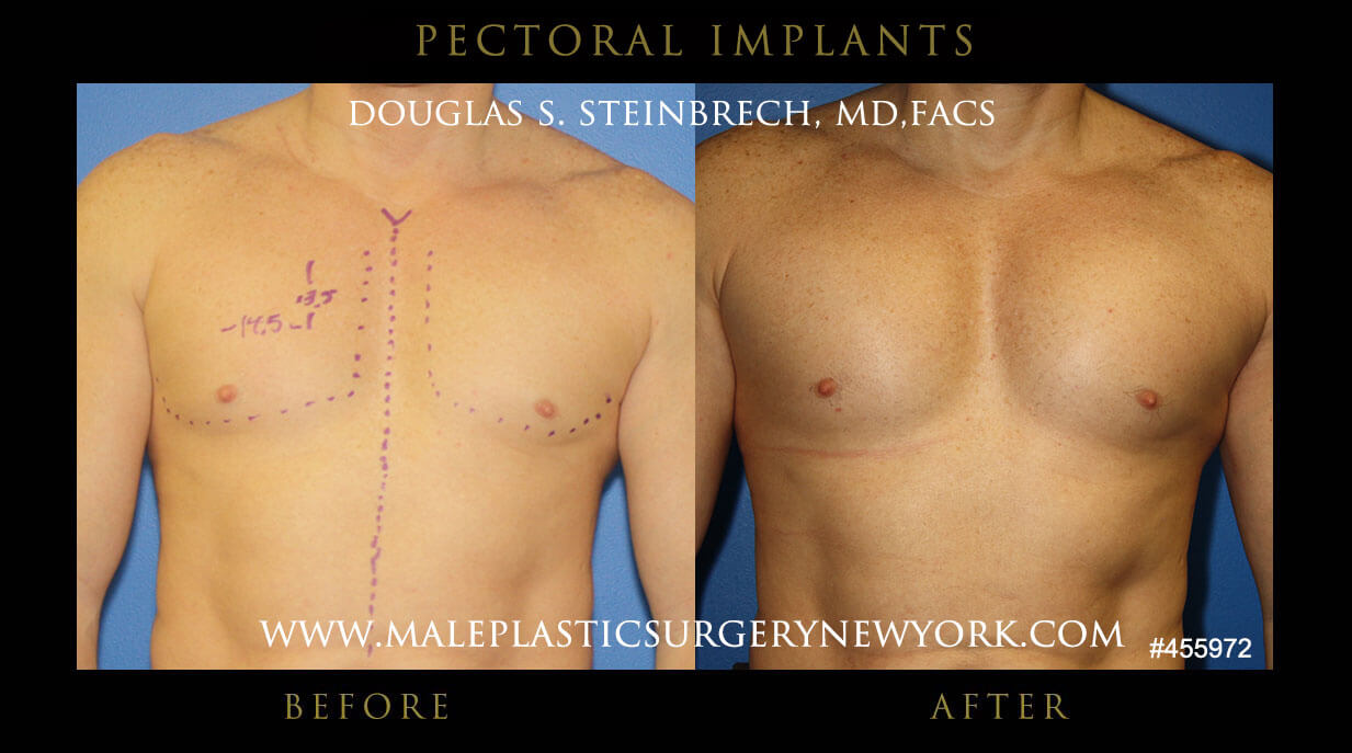 pectoral implants for men