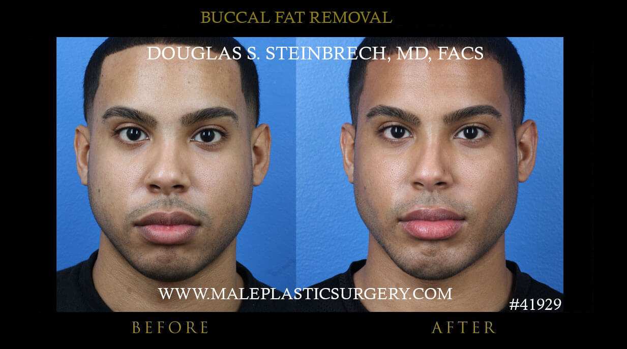 can men get fat removed from their face?