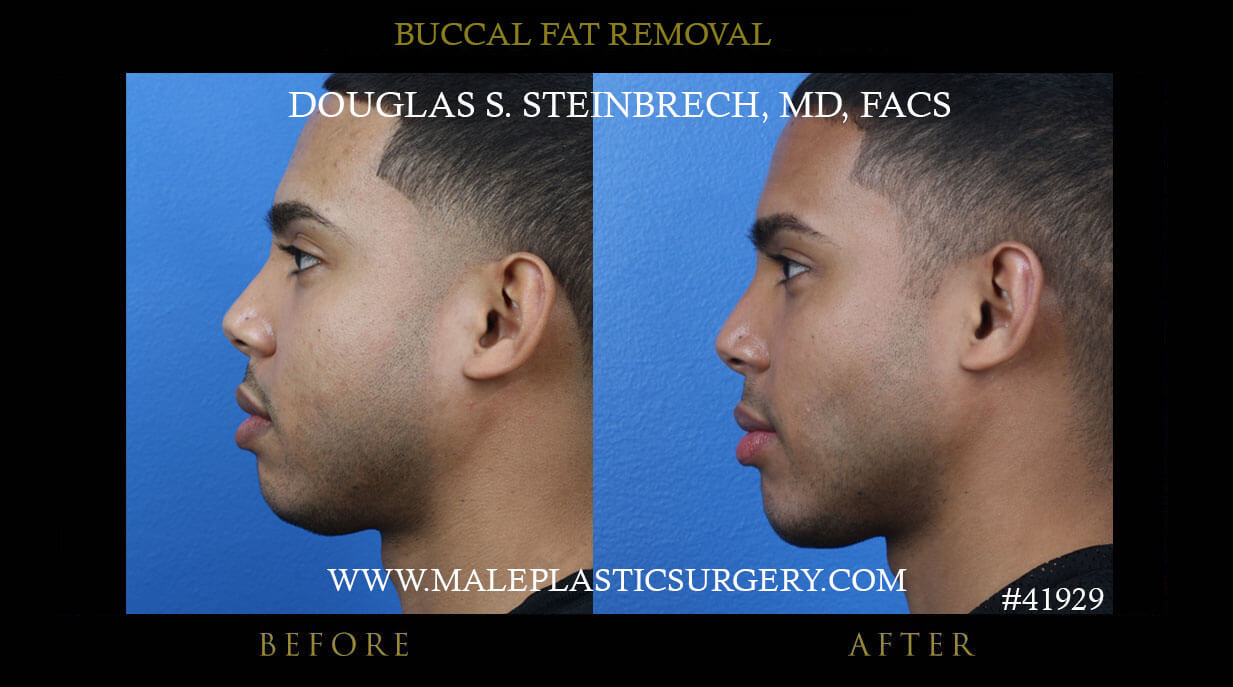 how much does buccal fat removal cost?
