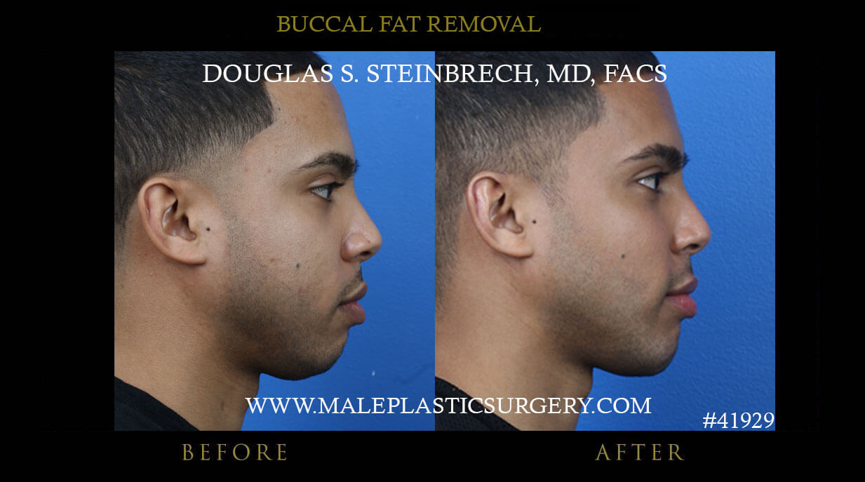 man with buccal fat