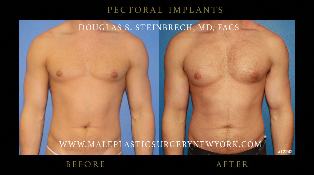 male breast implants cost