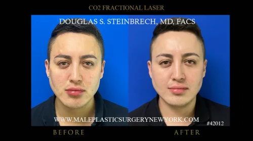 Fractional CO2 Laser – Face - Before & After Photo