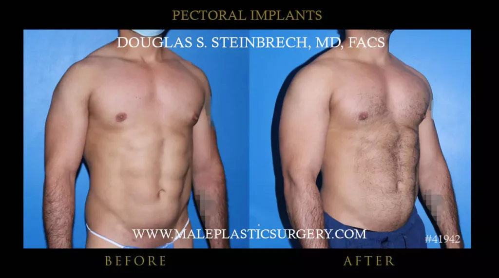 Pec Implants Before And After Photos Male Plastic Surgery