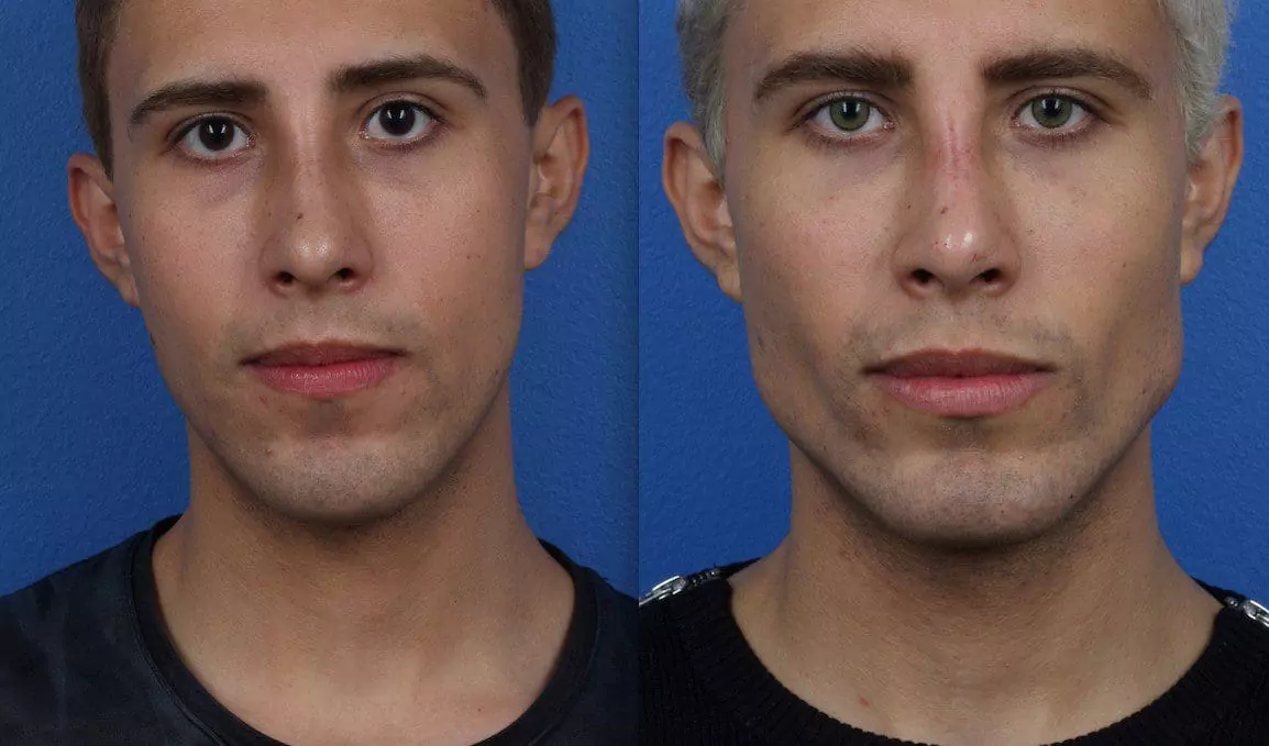 Jaw augmentation for men