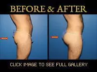 Gluteal (buttock) enhancement before and after photo 