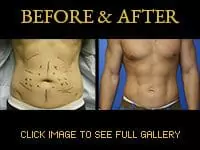 hi-def lipo for men before and after photo 